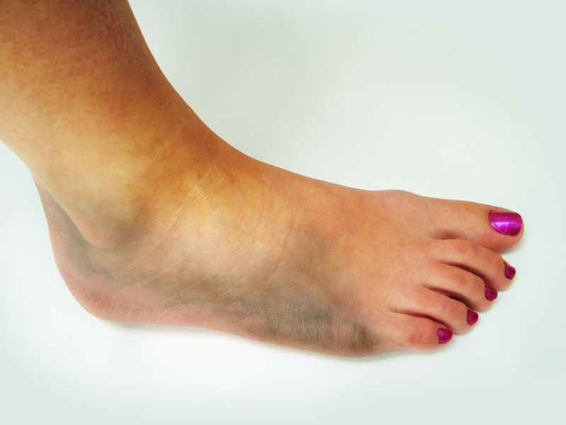 Need Ankle Surgery? Find an Ankle Surgeon in the Racine, WI