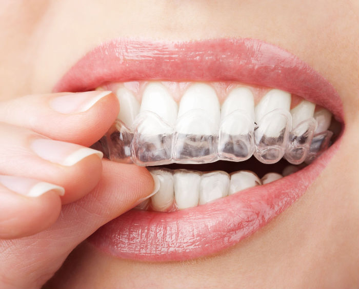 Reasons You Should Find an Invisalign Dentist in Springfield, NJ