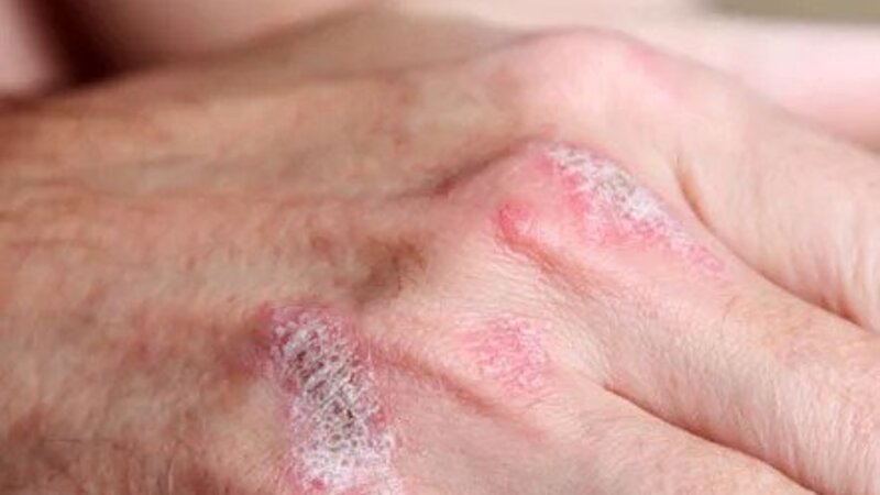 Effective Eczema Treatment in Spicer, MN, Isn’t Hard to Find