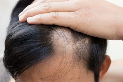 Discover All of the Benefits of a Hair Transplant in Washington, DC